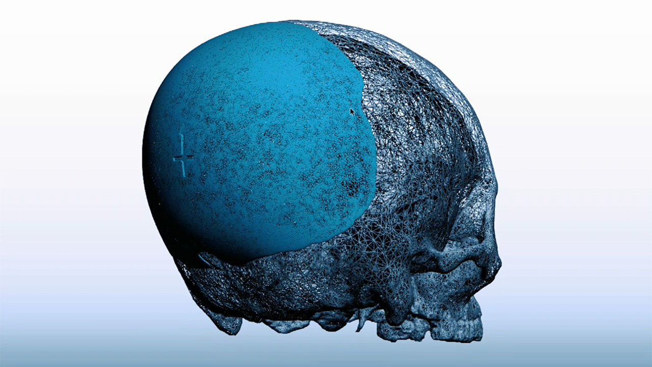 See how Dr. Eppley is changing lives with skull reshaping surgery